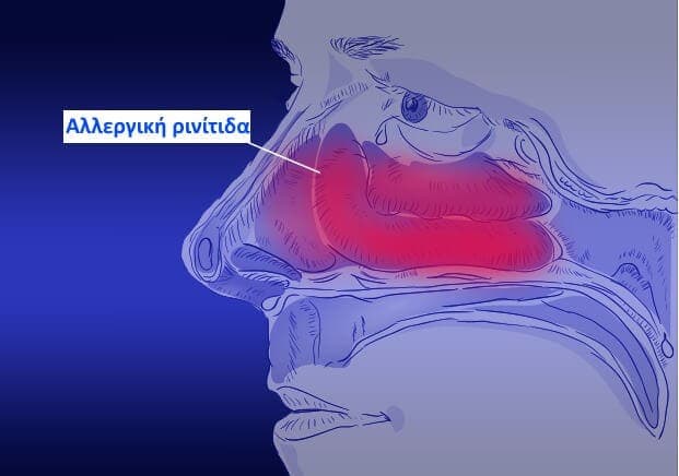 Αλλεργική ρινίτιδα