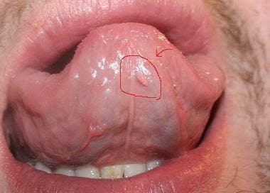 Ιός HPV: Συμπτώματα και θεραπεία