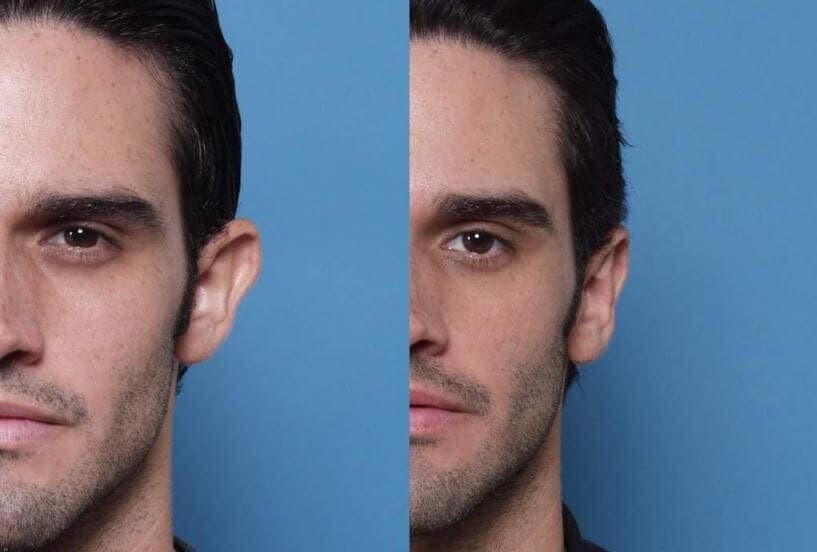 Ωτοπλαστική