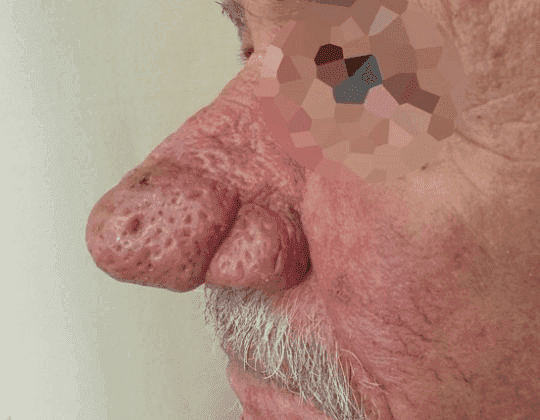 Ρινόφυμα