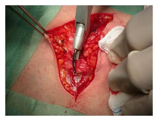 Video Endoscopic Thyroidectomy