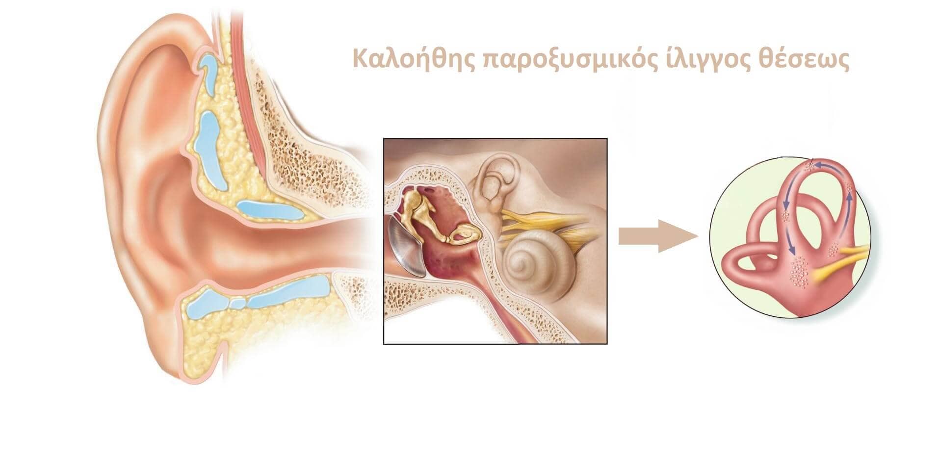Καλοήθης παροξυσμικός ίλιγγος θέσης (BPPV)
