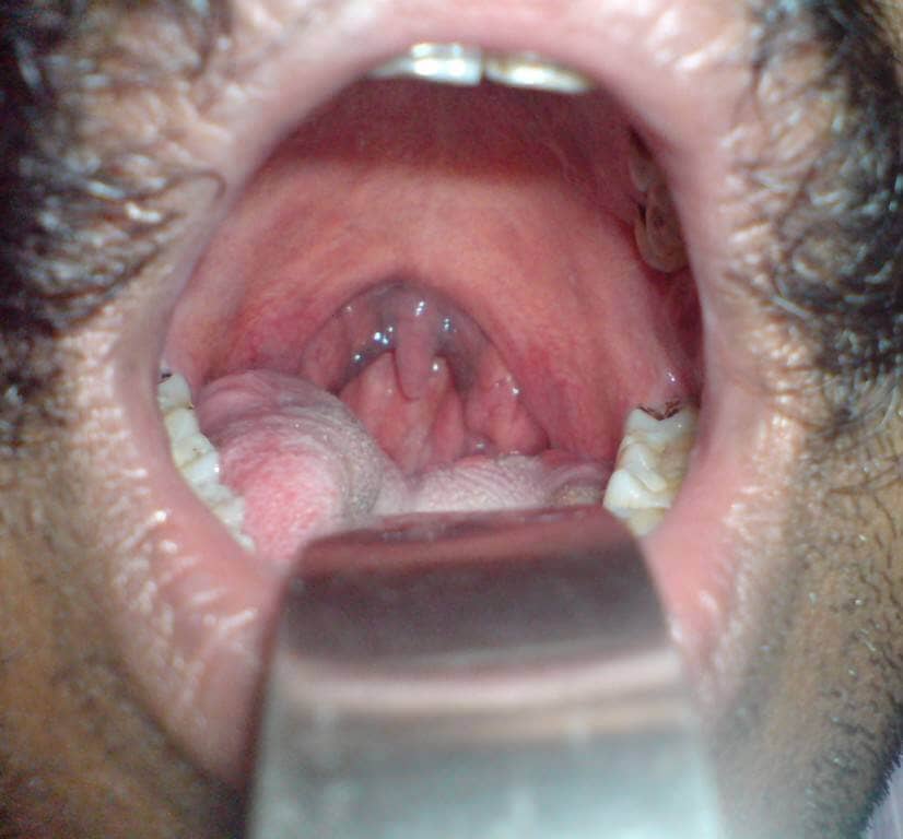 https://myorl.gr/ru/files/images/diseases/treatment-snoring/snrorer-blue-uvula.jpg